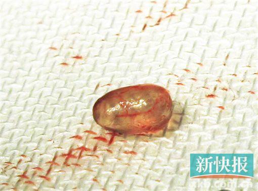 <em>女子</em>胸部长鱼卵被摘除 奥美定<em>注射丰胸</em>惹祸 