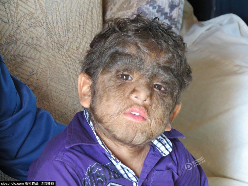 墨西哥狼人家族30多人天生长毛