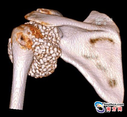 深圳15岁女孩肩膀长出数百粒珍珠