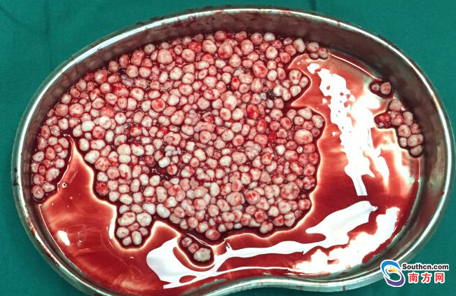 深圳15岁女孩肩膀长出数百粒珍珠