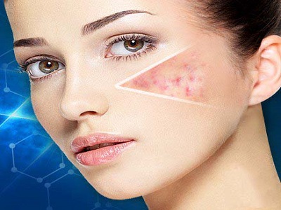 中年人也得青春痘